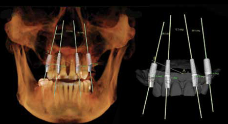 Implant Planning