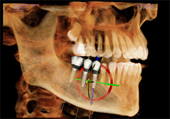 Implant Planning