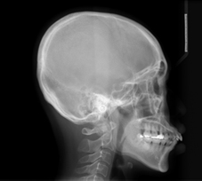 Lateral Cephalogram