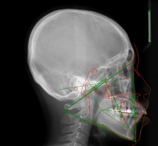 Lateral Cephalogram